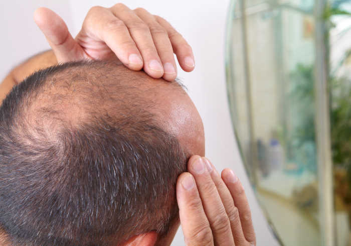 Middle-aged man concerned with hair loss baldness | Does MK-677 Cause Hair Loss?