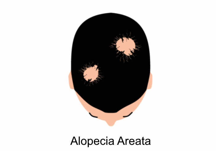 alopecia areata | Does MK-677 Cause Hair Loss