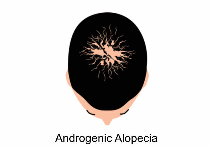 androgenic alopecia | Does MK-677 Cause Hair Loss