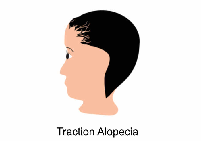 traction alopecia | Does MK-677 Cause Hair Loss